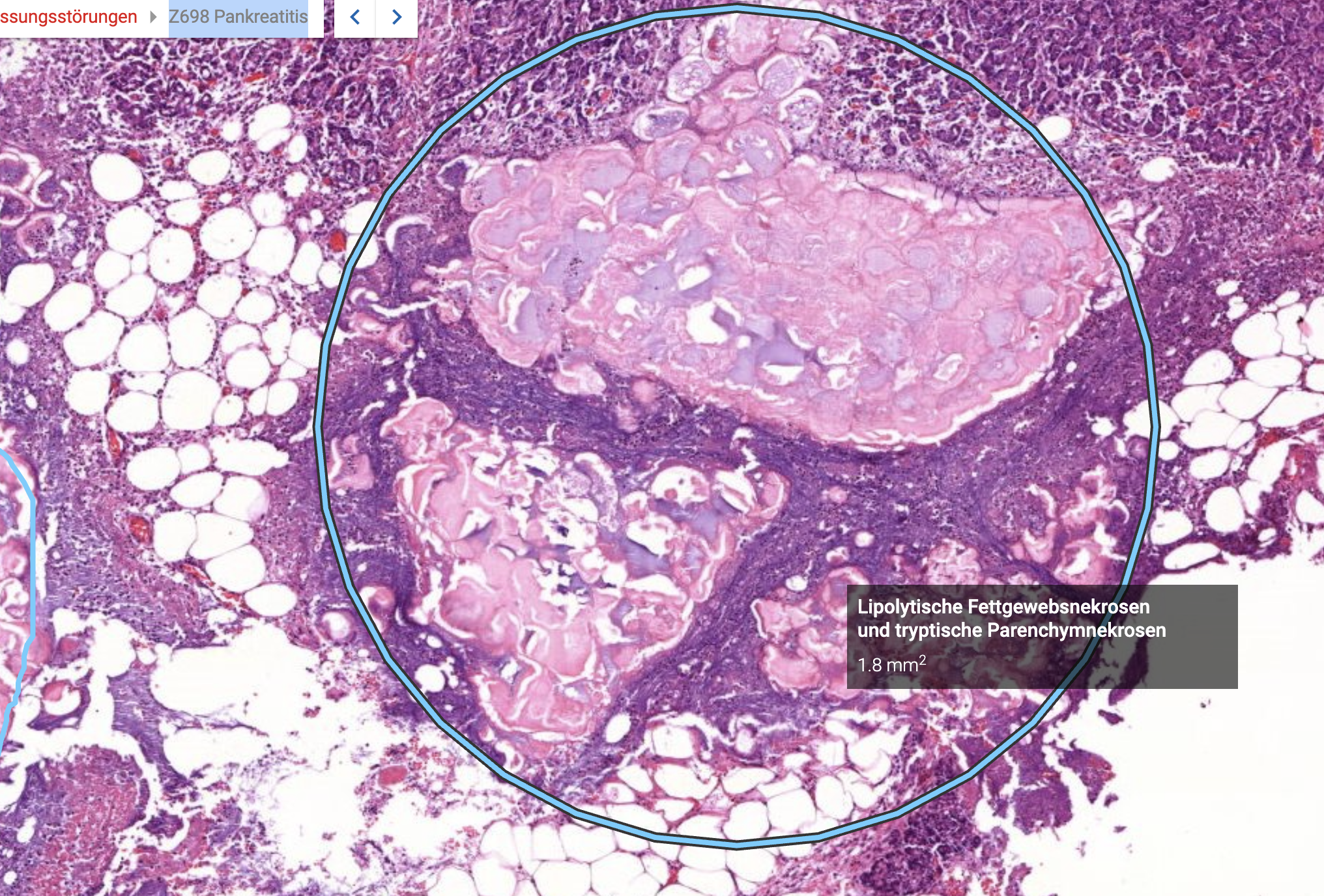 Histopathologisches Bild: Prostatahyperplasie mit knotiger Architektur